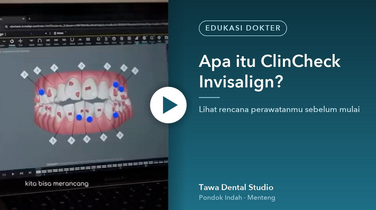 Cover video: Apa itu ClinCheck Invisalign?