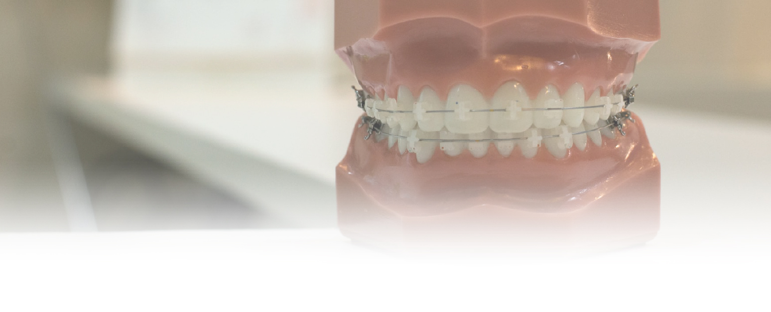 Braces (Orthodontics) — Tawa Dental Studio
